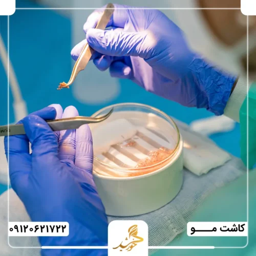 چند گرافت برای کاشت مو پیشانی بلند لازم است؟