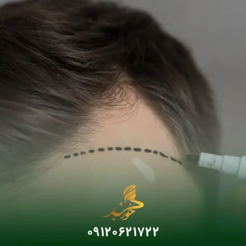 کاشت مو برای افرادی با پیشانی بلند