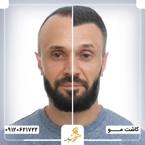کاشت مو پیشانی بلند با بهترین روش ها در کلینیک خورشید