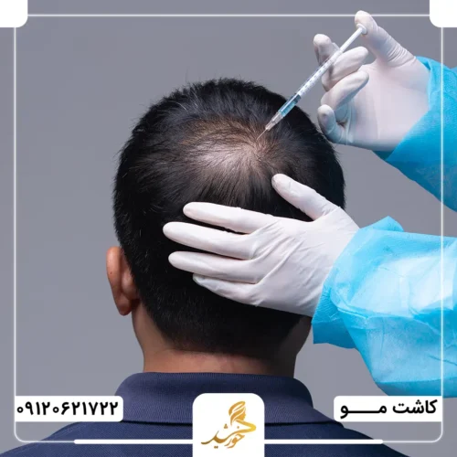 آیا بعد از کاشت مو باید مزوتراپی کرد؟