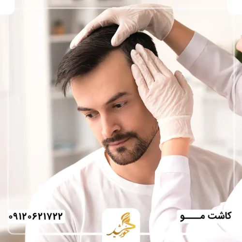 بهترین زمان شروع مزوتراپی بعد از پیوند مو