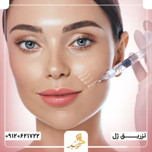 تزریق ژل خط خنده در کلینیک زیبایی خورشید