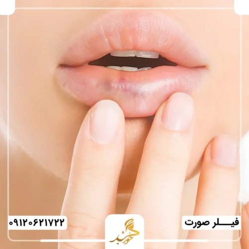 کبودی پس از تزریق فیلر صورت