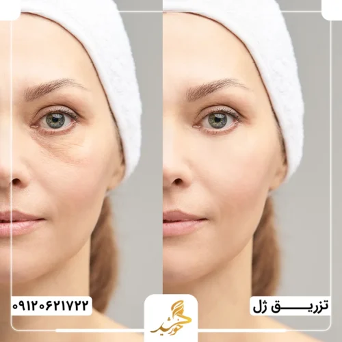 تاثیر تزریق ژل بر گودی زیر چشم