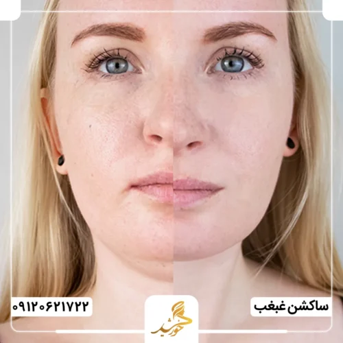 تاثیر لیپوساکشن غبغب در زاویه سازی صورت