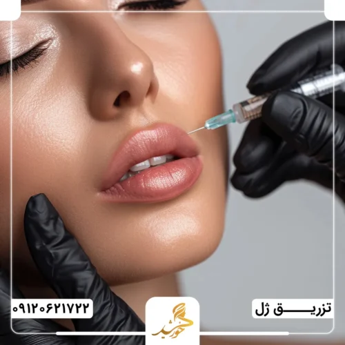 تزریق ژل لب با بهترین مواد در کلینیک زیبایی خورشید
