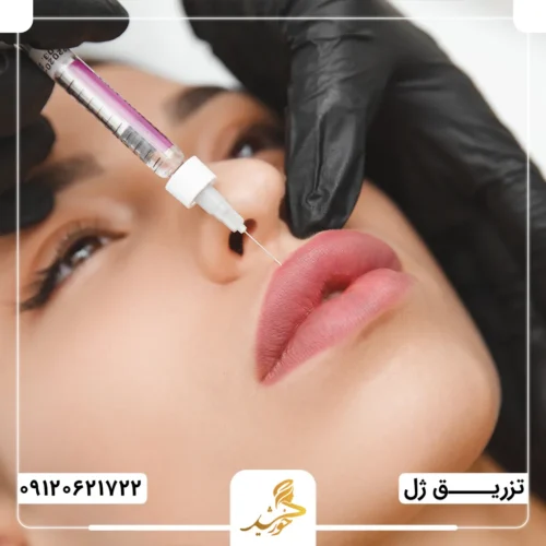 میزان حدودی ژل مورد نیاز برای تزریق به لب